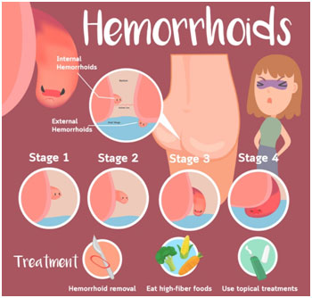 hemorrhoidstreament